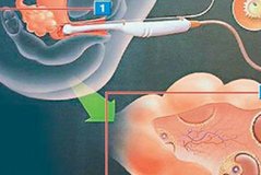 排卵障碍不容忽视，不孕大多是其原因！集安市哪家医院擅长排卵障碍试管方案？
